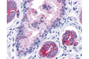 Anti-TNIK antibody IHC of human Prostate, Carcinoma. (TNIK anticorps  (Internal Region))