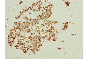 Immunohistochemistry of paraffin-embedded human breast cancer using ABIN7145831 at dilution of 1:100