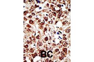 Formalin-fixed and paraffin-embedded human cancer tissue reacted with FDFT1 polyclonal antibody  , which was peroxidase-conjugated to the secondary antibody, followed by DAB staining .