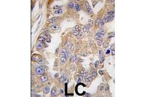 Formalin-fixed and paraffin-embedded human lung carcinoma tissue reacted with AGR2 antibody (Center), which was peroxidase-conjugated to the secondary antibody, followed by DAB staining. (AGR2 anticorps  (AA 95-124))