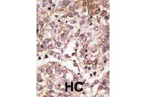 Formalin-fixed and paraffin-embedded human hepatocellular carcinoma tissue reacted with SIGLEC7 polyclonal antibody  , which was peroxidase-conjugated to the secondary antibody, followed by AEC staining. (SIGLEC7 anticorps  (N-Term))