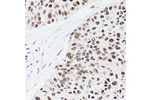 Immunohistochemistry of paraffin-embedded Human lung cancer using EP300 antibody (ABIN6127823, ABIN6140193, ABIN6140194 and ABIN6216844) at dilution of 1:100 (40x lens).