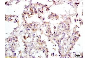Formalin-fixed and paraffin embedded human breast carcinoma labeled with Anti-PRKCDBP Polyclonal Antibody, Unconjugated (ABIN762206) at 1:200 followed by conjugation to the secondary antibody and DAB staining
