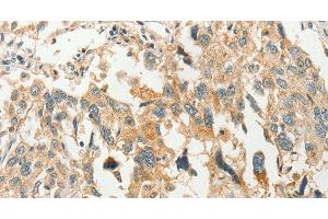 Immunohistochemistry of paraffin-embedded Human esophagus cancer tissue using SLC11A2 Polyclonal Antibody at dilution 1:50 (SLC11A2 anticorps)