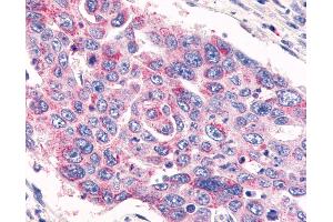 Anti-GPR26 antibody IHC of human Colon, Carcinoma. (GPR26 anticorps  (Cytoplasmic Domain))