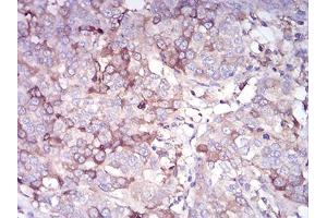 Immunohistochemical analysis of paraffin-embedded bladder cancer tissues using CDH11 mouse mAb with DAB staining.