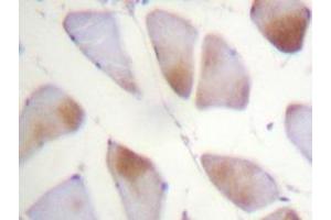 Immunohistochemistry analyzes of Crystallin-αB antibody in paraffin-embedded human breast carcinoma tissue. (CRYAB anticorps)