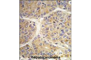 Formalin-fixed and paraffin-embedded human hepatocarcinoma tissue reacted with the AASS antibody , which was peroxidase-conjugated to the secondary antibody, followed by DAB staining. (AASS anticorps  (AA 264-294))