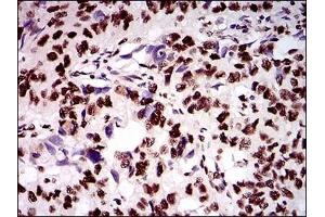 Immunohistochemical analysis of paraffin-embedded human esophageal cancer tissues using KIAA1967 mouse mAb with DAB staining.