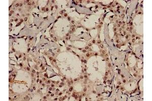 Immunohistochemistry analysis of human breast cancer using ABIN7159096 at dilution of 1:100 (MDC1 anticorps  (AA 1892-2082))