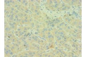 Immunohistochemistry of paraffin-embedded human liver cancer using ABIN7146168 at dilution of 1:100