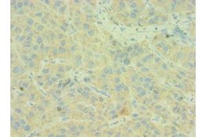 Immunohistochemistry of paraffin-embedded human liver cancer using ABIN7146168 at dilution of 1:100 (C4BPB anticorps  (AA 18-252))