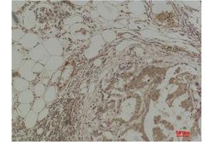 Immunohistochemical analysis of paraffin-embedded Human Breast Carcinoma using Pan Methylated Lysine Monoclonal Antibody. (Methylated Lysine anticorps)