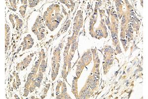 ABIN6265478 and ABIN6279868 at 1/100 staining Human pancreatic cancer by IHC-P. (TBC1D2 anticorps  (N-Term))