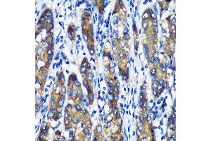 Immunohistochemistry of paraffin-embedded Human liver cancer using TXNDC12 Rabbit pAb (ABIN7270800) at dilution of 1:100 (40x lens).
