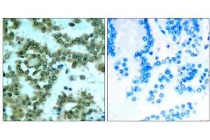 Immunohistochemical analysis of paraffin-embedded human lung carcinoma tissue, using PKCθ (phospho- Ser676) antibody (E011297). (PKC theta anticorps  (pSer676))