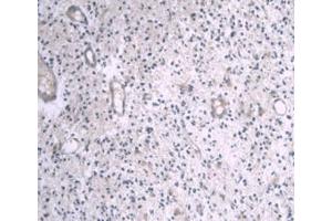 DAB staining on IHC-P; Samples: Human Glioma Tissue (APOA1 anticorps  (AA 122-267))