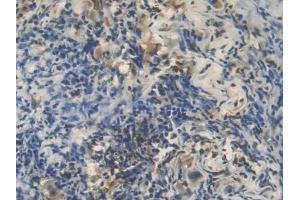 Detection of HSPA1A in Human Lung cancer Tissue using Polyclonal Antibody to Heat Shock 70 kDa Protein 1A (HSPA1A)