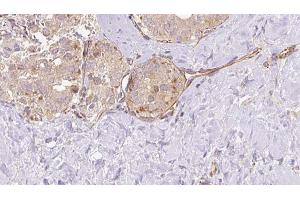 ABIN6273326 at 1/100 staining Human thyroid cancer tissue by IHC-P. (SUOX anticorps  (Internal Region))