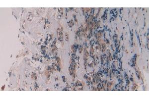 Detection of MMP11 in Human Breast cancer Tissue using Polyclonal Antibody to Matrix Metalloproteinase 11 (MMP11)