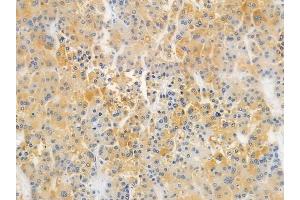 ABIN6259434 and ABIN6276263 at 1/100 staining human hepatocellular carcinoma by IHC-P.