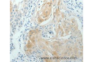 Immunohistochemistry of Human cervical cancer using RNF126 Polyclonal Antibody at dilution of 1:70