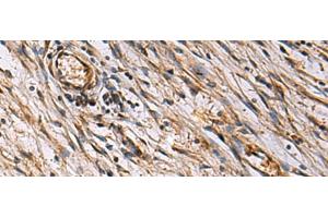 Immunohistochemistry of paraffin-embedded Human colorectal cancer tissue using ECM1 Polyclonal Antibody at dilution of 1:25(x200) (ECM1 anticorps)