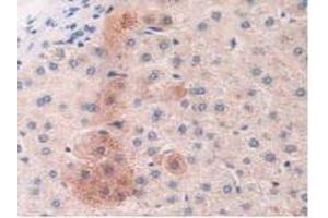 Detection of MASP2 in Human Liver Cancer Tissue using Polyclonal Antibody to Mannose Associated Serine Protease 2 (MASP2) (MASP2 anticorps  (AA 445-683))