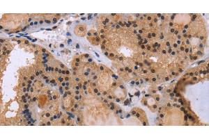 Immunohistochemistry of paraffin-embedded Human thyroid cancer tissue using KIF25 Polyclonal Antibody at dilution 1:40 (KIF25 anticorps)