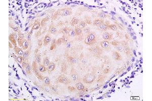 Formalin-fixed and paraffin embedded human oral squamous cell carcinoma labeled with Anti- MUC4 Polyclonal Antibody, Unconjugated  at 1:200 followed by conjugation to the secondary antibody and DAB staining