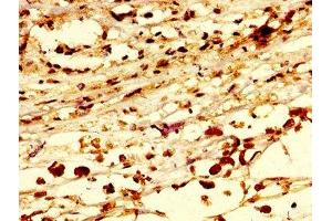 IHC image of ABIN7168252 diluted at 1:300 and staining in paraffin-embedded human melanoma performed on a Leica BondTM system. (RNF219 anticorps  (AA 257-465))