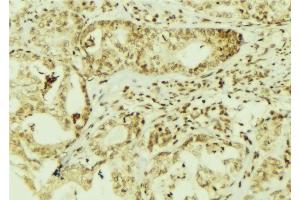 ABIN6267095 at 1/100 staining Human breast cancer tissue by IHC-P. (BAP1 anticorps  (pSer592))