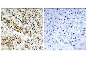 Immunohistochemistry analysis of paraffin-embedded human breast carcinoma tissue using CtBP1 (epitope around residue 422) antibody. (CTBP1 anticorps  (Ser422))