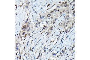 Immunohistochemistry of paraffin-embedded human esophageal cancer using C9orf72 Rabbit pAb (ABIN7266391) at dilution of 1:100 (40x lens).