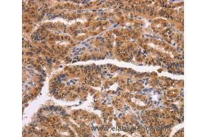 Immunohistochemistry of Human liver cancer using NCAPG2 Polyclonal Antibody at dilution of 1:50 (NCAPG2 anticorps)