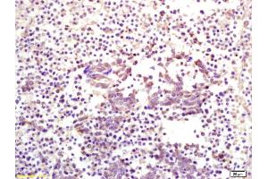 Formalin-fixed and paraffin embedded human lung carcinoma labeled with Anti CKIP-1 Polyclonal Antibody, Unconjugated (ABIN675039) at 1:200 followed by conjugation to the secondary antibody and DAB staining (PLEKHO1 anticorps  (AA 51-170))