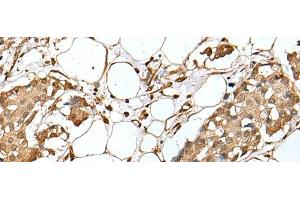 Immunohistochemistry of paraffin-embedded Human breast cancer tissue using UBE2Z Polyclonal Antibody at dilution of 1:35(x200)