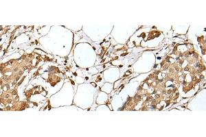 Immunohistochemistry of paraffin-embedded Human breast cancer tissue using UBE2Z Polyclonal Antibody at dilution of 1:35(x200) (UBE2Z anticorps)