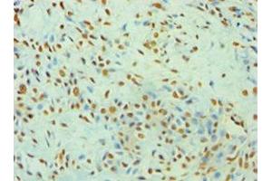 Immunohistochemistry of paraffin-embedded human breast cancer using ABIN7175904 at dilution of 1:100 (XRCC5 anticorps  (AA 543-732))