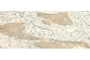 Immunohistochemistry of paraffin-embedded Human esophagus cancer tissue using MPV17 Polyclonal Antibody at dilution of 1:50(x200) (MPV17 anticorps)