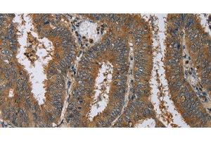 Immunohistochemistry of paraffin-embedded Human colon cancer using HSP40-4 Polyclonal Antibody at dilution of 1:60 (HSP40-4 anticorps)