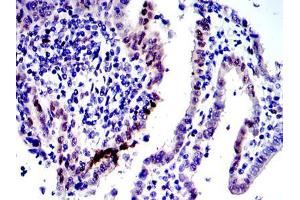 Immunohistochemical analysis of paraffin-embedded human intima canncer tissues using c-Jun mouse mAb with DAB staining.