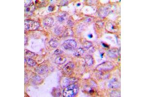 Immunohistochemical analysis of CARD6 staining in human lung cancer formalin fixed paraffin embedded tissue section.