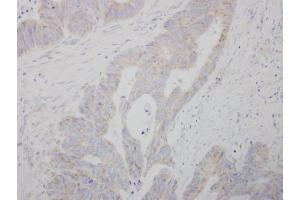 IHC-P Image COMT antibody detects COMT protein at cytosol on human colon carcinoma by immunohistochemical analysis. (COMT anticorps)