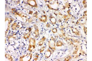 Anti- LOXL1 Picoband antibody, IHC(P) IHC(P): Human Prostatic Cancer Tissue