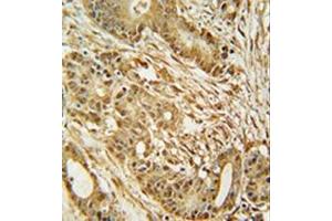 Immunohistochemistry analysis in formalin fixed and paraffin embedded human colon carcinoma reacted with MCM2 Antibody (C-term) followed which was peroxidase conjugated to the secondary antibody and followed by DAB staining. (MCM2 anticorps  (C-Term))