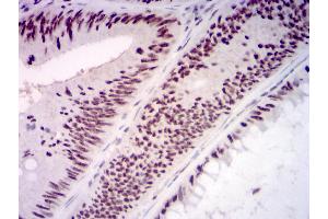 Immunohistochemical analysis of paraffin-embedded rectum cancer tissues using KMT2D mouse mAb with DAB staining. (Lysine (K)-Specific Methyltransferase 2B (KMT2B) (AA 445-599) anticorps)