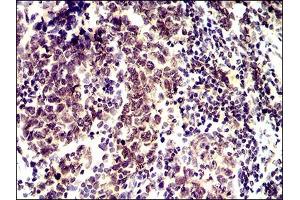 Immunohistochemical analysis of paraffin-embedded breast cancer tissues using ID2 mouse mAb with DAB staining.