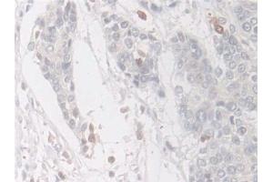 Detection of COTL1 in Human Prostate cancer Tissue using Polyclonal Antibody to Coactosin Like Protein 1 (COTL1)