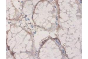 Immunohistochemistry of paraffin-embedded human colon cancer using ABIN7142468 at dilution of 1:20